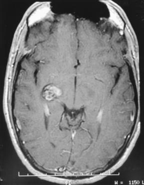 A B C Figure 5. Axial MRI scans of a cavernous angioma from patient 2.