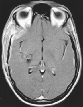 (B) On a long TR image, a hypointense ring (arrow) can be seen around the malformation as a result of hemosiderin deposition in the surrounding brain.