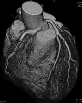 performed well allows the detection of coronary artery stenoses with high