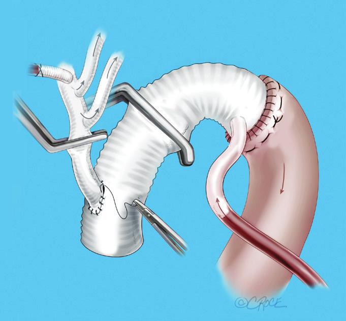 anastomosis is maintained via the same collaterals (see Figure 3); D.
