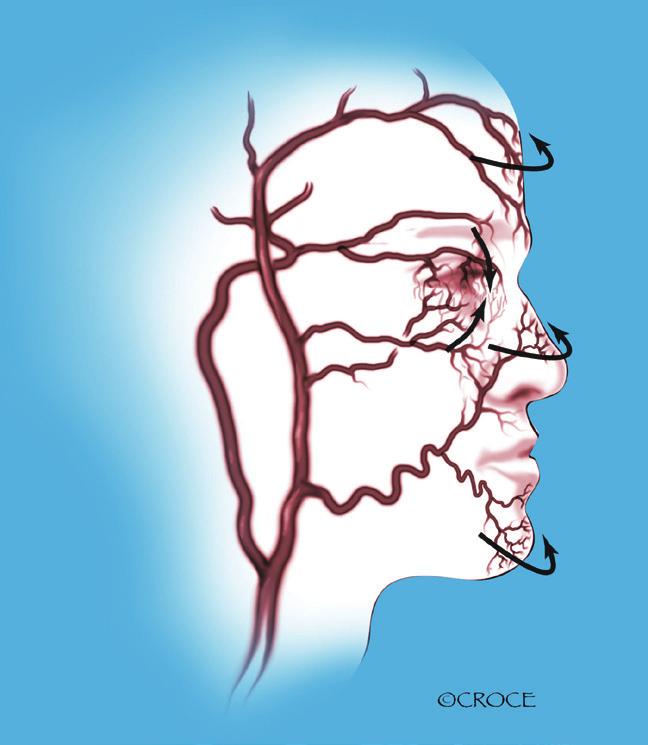 Annals of cardiothoracic surgery, Vol 2, No 2 March 2013 197 A B C D Figure 3 Apart from the circle of Willis there is a plethora of extra-cranial collateral channels that augment cerebral perfusion