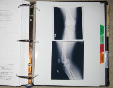 Case 10 was a patient with a bicondylar tibial plateau fracture.