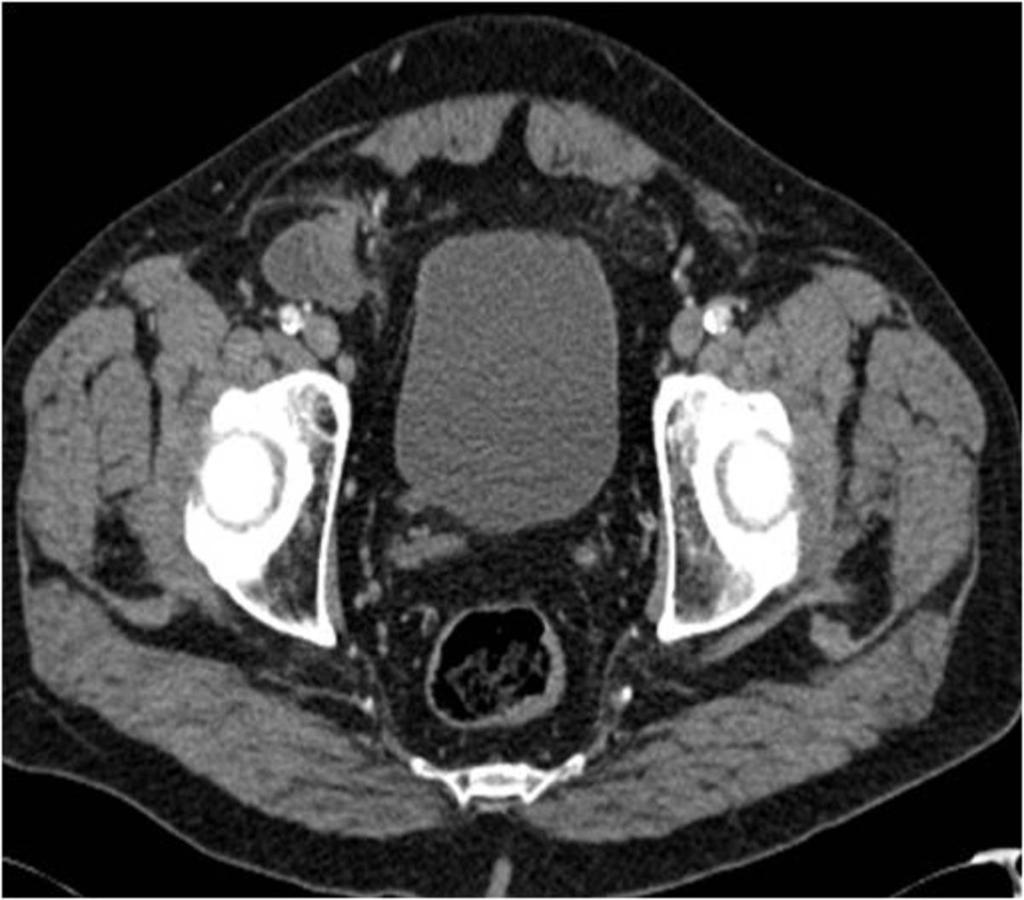Fig. 2: Axial contrast-enhanced CT image demonstrates the