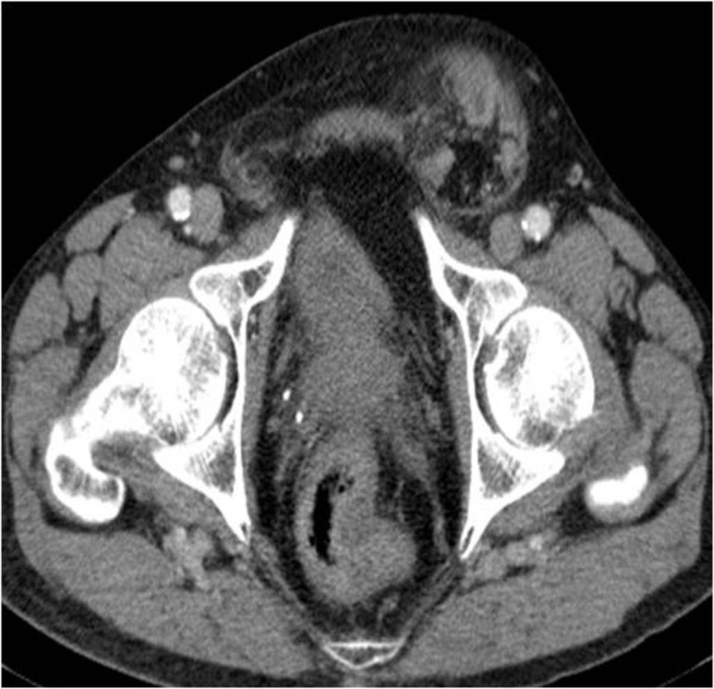 Fig. 4: Axial contrast-enhanced CT image shows bladder herniated in the right inguinal canal. Fig.