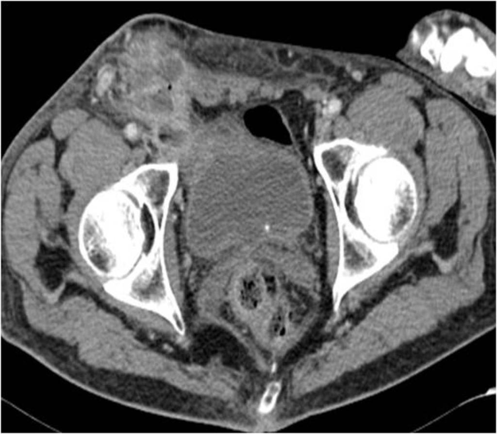Fig. 6: Axial contrast-enhanced CT image shows inflamed appendix herniated in the