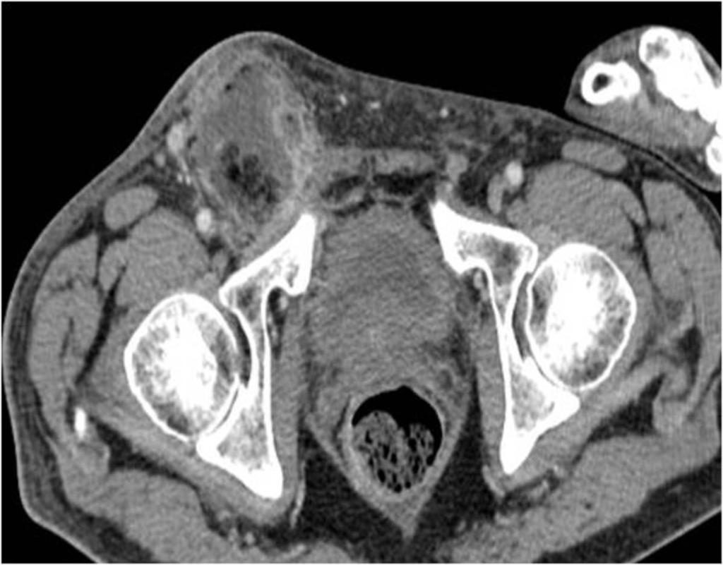 7: Axial contrast-enhanced CT image performed to the same patient of fig.