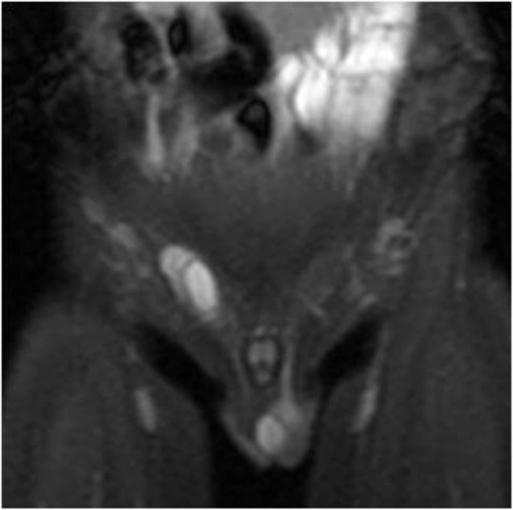 Fig. 10: Coronal T2-weighted fat supressed image taken in the same patient