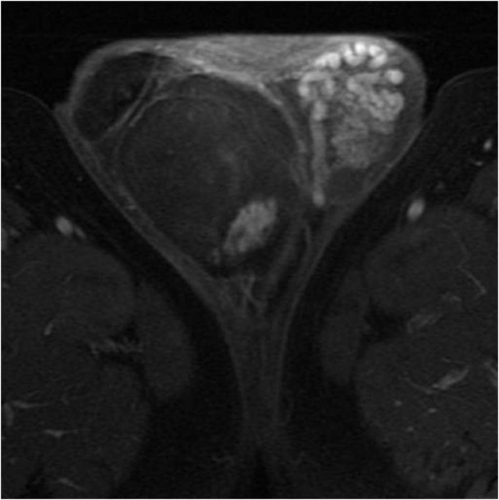 Fig. 14: Axial T1-weighted fat-supressed and contrast enhanced image shows low signal intensity of most of the tumor (the same of figs 11-13) demostrating fat composition.