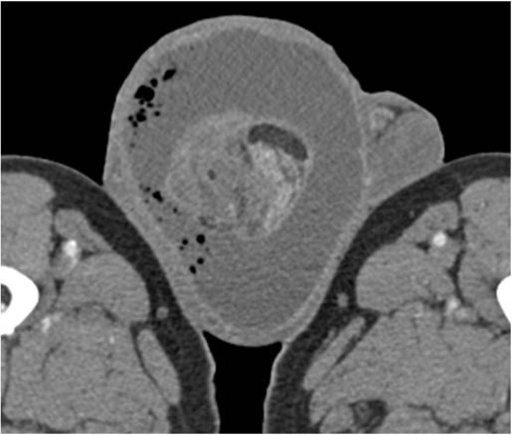 Fig. 15: Axial contrast-enhanced CT image shows fluid collection