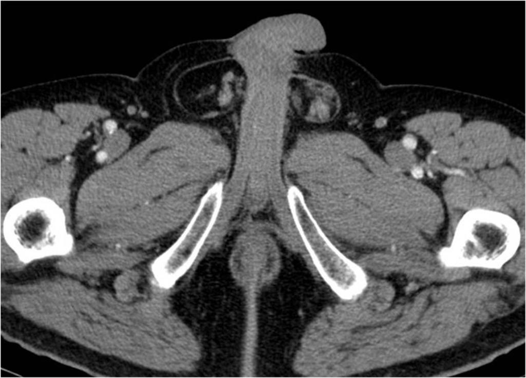 Fig. 16: Axial contrast-enhanced CT image shows right inguinal tubular