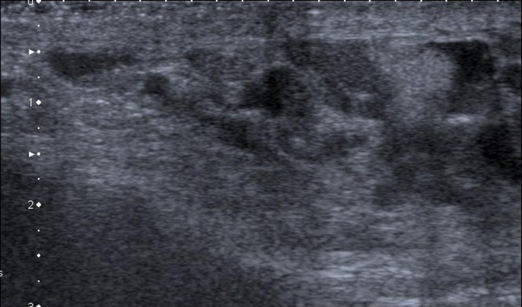 Fig. 17: US image shows varicocele as serpiginous