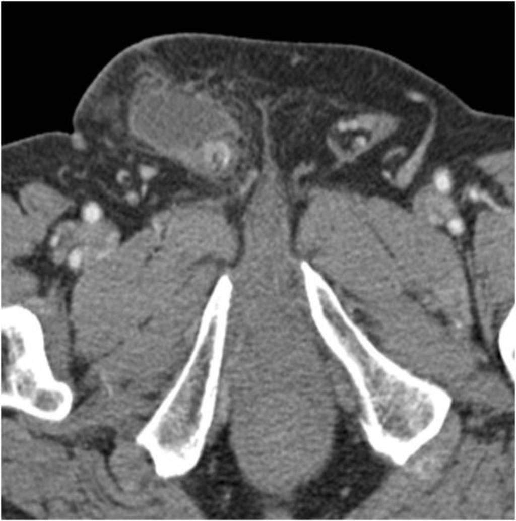 Fig. 20: Axial contrast-enhanced CT image shows a right fluid