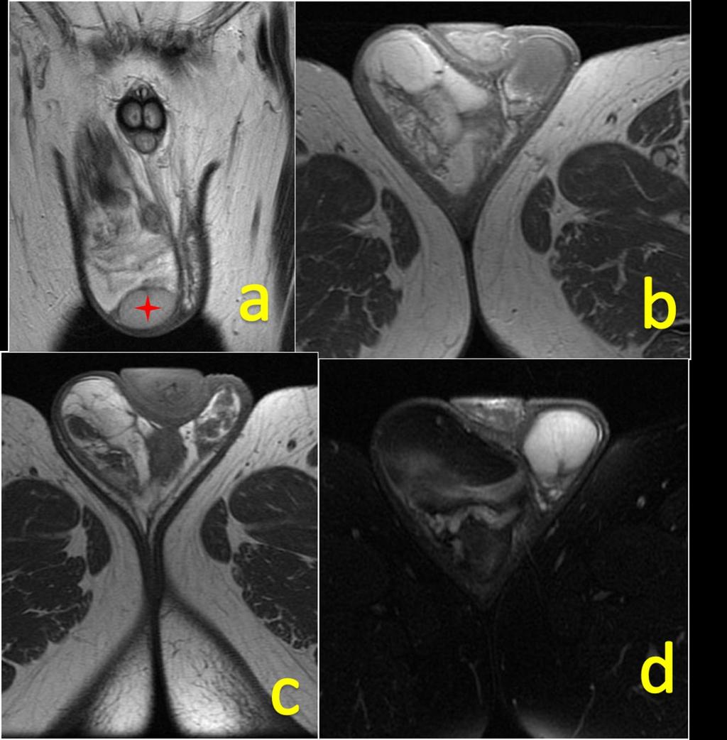 Fig. 24: Liposarcoma. Coronal T2-weighted (a), axial T2-weighted (b), axial T1weighted (c) and T2-weighted fat-supressed images show right inguino-scrotal mass with heterogeneous signal intensity.