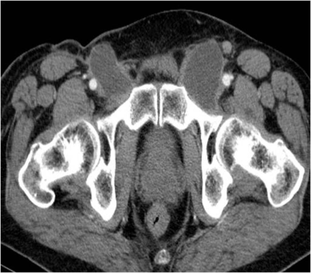 Fig. 26: Axial contrast-enhanced CT image shows bilateral inguinal