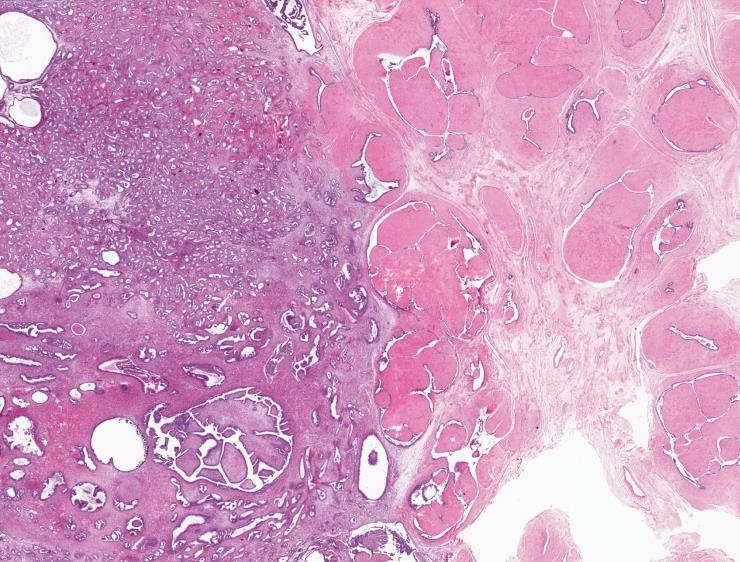 Phyllodes tumors may be less cellular or mimic fibroadenomas in