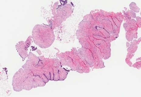 WHO 2012 OUR APPROACH: CELLULAR FIBROEPITHELIAL LESION; SEE COMMENT.