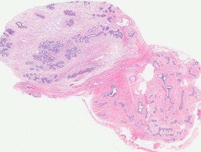 Features of cellular fibroepithelial lesions on core biopsy that may predict phyllodes tumor?