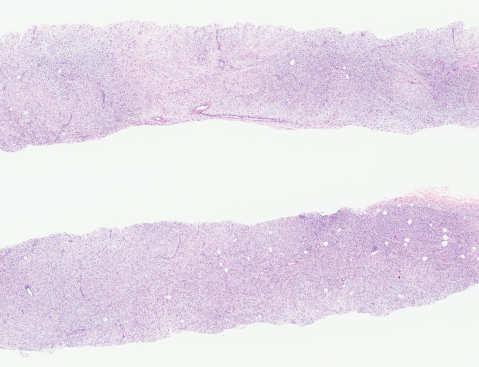 DIFFERENTIAL DIAGNOSIS Metaplastic carcinoma Phyllodes tumor Sarcoma Potential neoadjuvant