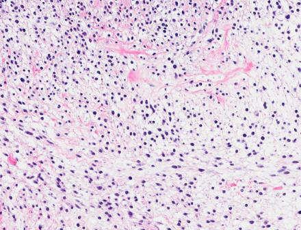 DIAGNOSIS Metaplastic carcinoma Phyllodes tumor Sarcoma KERATIN AND p63 EXPRESSION IN PHYLLODES