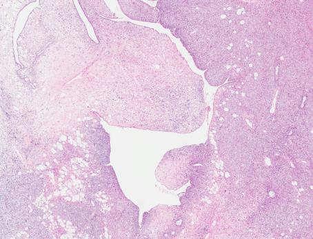 PHYLLODES TUMOR Phyllodes tumors may express cytokeratins and/or p63