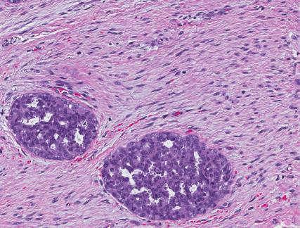 5% fibroepithelial lesions in tertiary