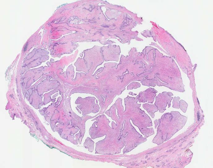 epithelial component arranged in clefts surrounded by a hypercellular stromal/mesenchymal component which in combination elaborate leaf-like structures PHYLLODES TUMOR DIAGNOSIS BASED ON A