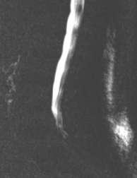Fig 6- MR Myelogram of the same patient shows abrupt termination of thecal sac at L5