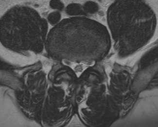 Fig - 7 Axial T2 images of the same patient show adequate lumbar spinal canal, but