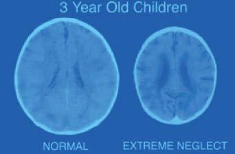 Impact of Neglect on a Developing Brain Bruce Perry (2004).