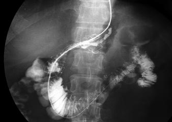 B, Upper gastrointestinal radiograph shows successful insertion of stent delivery system and loading of 0.