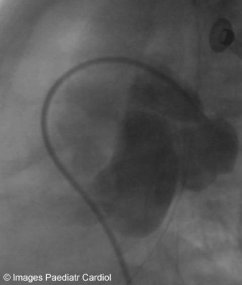 Figure 4 Lateral angiogram as figure 3 This clearly demonstrated a large fistulous connection,