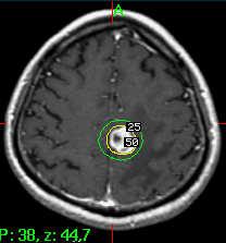 004 Decrease immediate and delayed recall Radiosurgery for Brain Mets Limited number of lesions < 3 cm in diameter 18 Gy at 55% IDL PR 6 mo p RS SRS for brain mets from NSCLCa Sheehan J