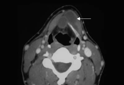 extending into the pre-epiglottic ft Figure 3 Axil short tu inversion recovery (STIR) MRI shows typicl loction of second rnchil cleft cyst (rrow).