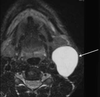 The differentil dignosis will lso include cystic lymphdenopthy Figure 4 T 2 weighted xil MRI scn shows well-defined lesion in the right posterior cervicl spce which is of very high