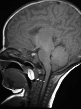 Cystic lesions in the suprhyoid neck EK Woo nd SEJ Connor 3 Figure 6 T 1 weighted xil MRI scn of lymphngiom which shows lrge high signl lesion involving the protid spce nd prphryngel spce (rrow).