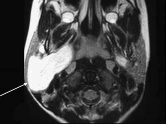 A first rnchil cleft cyst rises from the residul emryonic trct, which extends from the externl uditory cnl (EAC) through the protid glnd to the sumndiulr region.