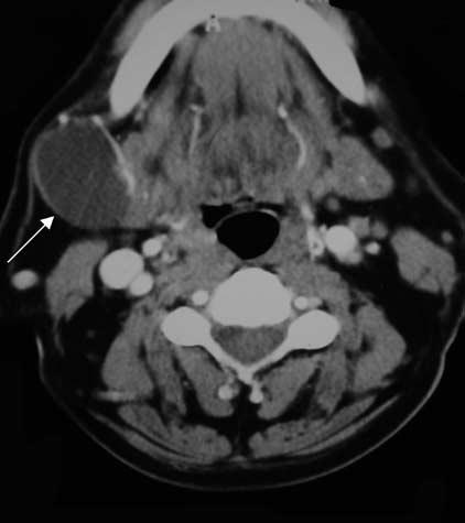 CT nd MRI show cystic lesion in the typicl loction. However, in most cses, it is difficult to differentite etween ny other cystic lesions in the protid glnd.