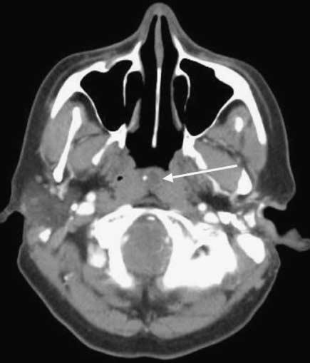 4 Cystic lesions in the suprhyoid neck EK Woo nd SEJ Connor Figure 9 () Axil T 2 weighted MRI shows high signl lesion in the left sulingul spce extending
