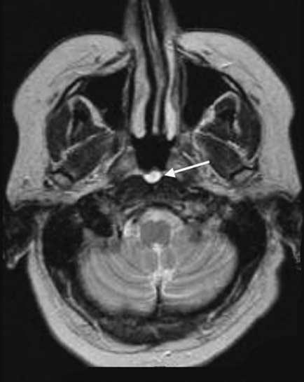 () Axil T 1 weighted MRI with gdolinium enhncement of the sme rnul showing minor rim enhncement of the cystic lesion (rrow) Figure 10 () An xil CT scn