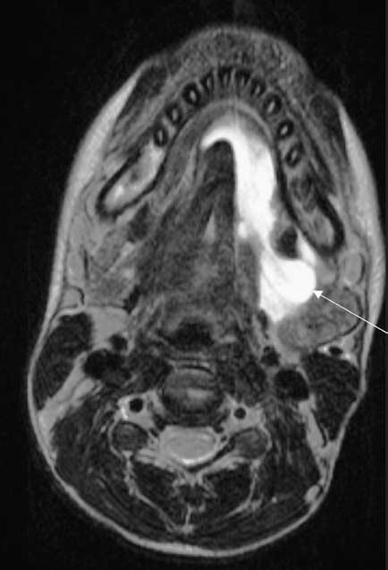 () T 2 weighted Axil MRI scn showing smll high signl well-defined lesion in the midline of the nsophrynx.