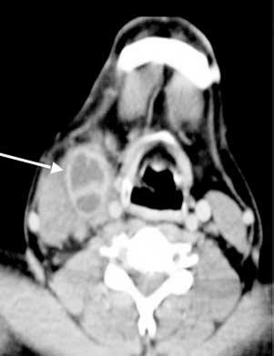 However, the differentil dignosis lso includes thyroglossl duct cyst. () Sgittl reconstructions in the sme ptient demonstrting the reltions of the cyst within the vllecul (rrow).