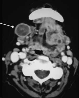 Both dermoid nd epidermoid cysts re composed of Figure 15 Axil CT scn (soft tissue lgorithm) with intrvenous contrst shows lrge cystic lesion in the posterior cervicl spce in the infrhyoid neck.
