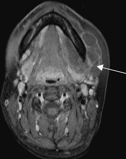6 Cystic lesions in the suprhyoid neck EK Woo nd SEJ Connor Q2 Figure 17 () Axil CT scn (soft tissue lgorithm) shows ilterl multiple cystic lesions in oth the deep nd superficil loes of the protid
