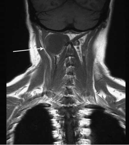 Cystic lesions in the suprhyoid neck EK Woo nd SEJ Connor 7 utoimmune disese (e.g.