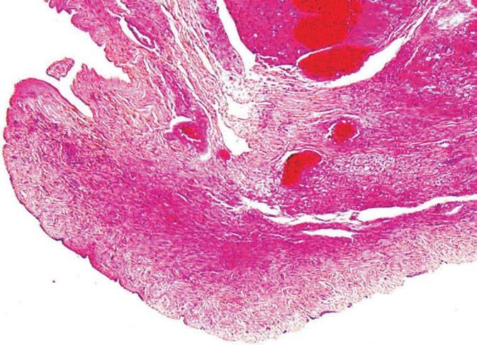 Figure 4 Two transversal section of complete androgen insensitivity testis at