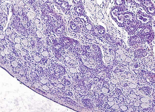 (HES, 20) Figure 7 Dysgenetic testis of an altering variety of mixed gonadal dysgenesis showing