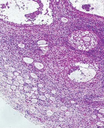 Figure 8 Gonadoblastoma developed in a streak gonad.