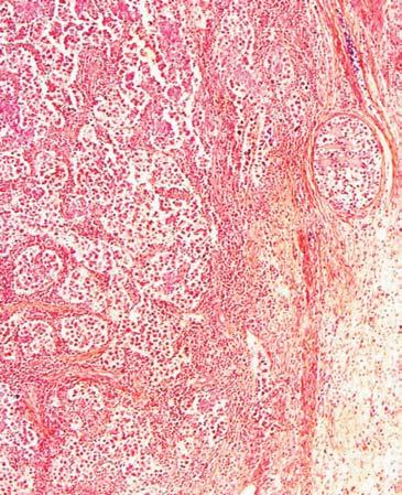 The PLAP immunochemical stain outlines the malignant germ cells and their spillover in the nearby tissue.