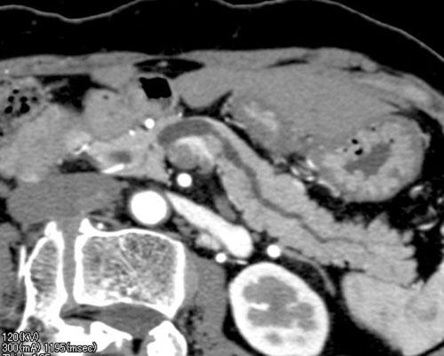 The type of resection performed was determined on the basis of the location of the pancreatic lesions on CT.