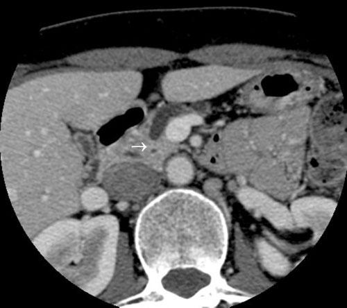 Imaging of early pancreatic cancer on multidetector row helical CT Analysis of imaging and pathological findings Pathological findings were evaluated with respect to location, size and histological